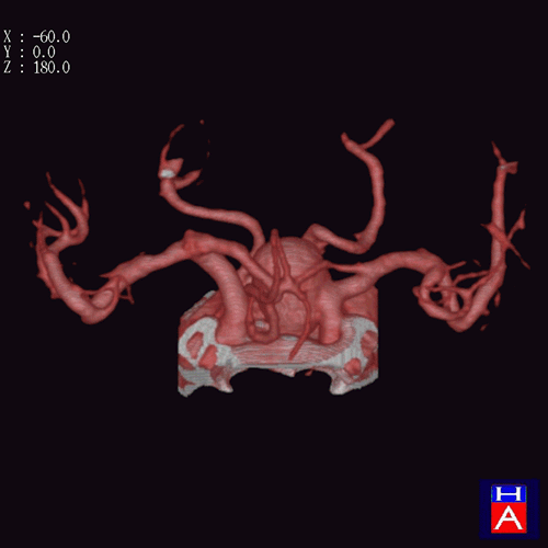 3D-CTアンギオ (内頸動脈瘤)