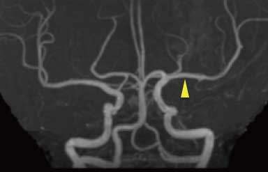 t-PA静注療法で再開通した血管